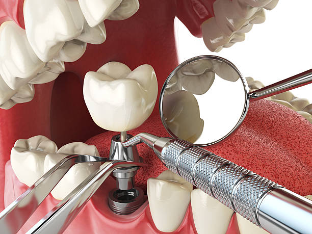 Best Emergency Dentist for Lost Fillings or Crowns in Aspen Hill, MD